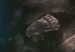 Ultrasound Picture of Baby-Girl at 28w4d